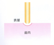 炭酸ガスレーザー