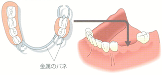 奥歯を含めて複数の歯を失った場合